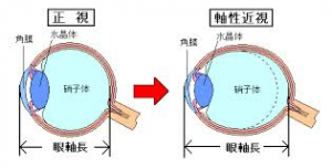 近視と眼軸長の関係